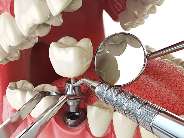 Best Knocked-Out Tooth (Avulsed Tooth) Treatment in Lambertville, MI